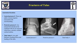 Fractures and Dislocations of Foot - Dr Sunkappa SR | PPTX