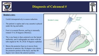 Fractures and Dislocations of Foot - Dr Sunkappa SR | PPTX