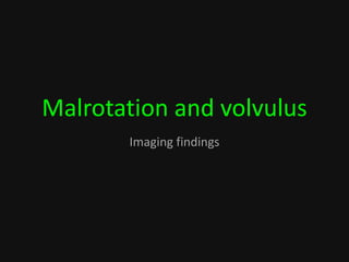 Malrotation and volvulus
Imaging findings
 