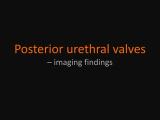 Posterior urethral valves
– imaging findings
 