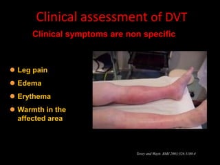 Clinical assessment of DVT
      Clínical symptoms are non specific



 Leg pain
 Edema
 Erythema
 Warmth in the
  affected area



                              Tovey and Waytt. BMJ 2003;326:1180-4
 