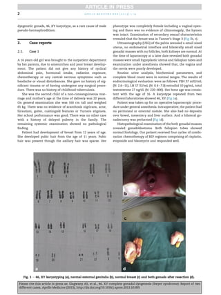 dysgenetic gonads, 46, XY karyotype, as a rare cause of male
pseudo-hermaphroditism.
2. Case reports
2.1. Case 1
A 16 years old girl was brought to the outpatient department
by her parents, due to amenorrhea and poor breast develop-
ment. The patient did not give any history of cyclical
abdominal pain, hormonal intake, radiation exposure,
chemotherapy or any central nervous symptoms such as
headache or visual disturbances. She gave no history of sig-
niﬁcant trauma or of having undergone any surgical proce-
dure. There was no history of childhood tuberculosis.
She was the second child of a non-consanguineous mar-
riage and mother’s age at the time of delivery was 20 years.
On general examination she was 160 cm tall and weighed
65 kg. There was no evidence of acanthosis nigricans, acne,
hirsutism, goiter, cushingoid features or Turners stigmata.
Her school performance was good. There was no other case
with a history of delayed puberty in the family. The
remaining systemic examination showed no pathological
ﬁnding.
Patient had development of breast from 12 years of age.
She developed pubic hair from the age of 11 years. Pubic
hair was present though the axillary hair was sparse. Her
phenotype was completely female including a vaginal open-
ing and there was no evidence of clitoromegaly, the hymen
was intact. Examination of secondary sexual characteristics
revealed that the breast was in Tanner’s Stage 3 (Fig 1b, c).
Ultrasonography (USG) of the pelvis revealed a small sized
uterus, no endometrial interface and bilaterally small sized
gonadal masses with no follicles, both kidneys are normal. At
the time of laparoscopy at a later date revealed both gonadal
masses were small hypoplastic uterus and fallopian tubes and
examination under anesthesia showed that, the vagina and
the cervix were poorly developed.
Routine urine analysis, biochemical parameters, and
complete blood count were in normal ranges. The results of
endocrinological evaluation were as follows: FSH 37 mIU/mL
(N: 2.6e11), LH 17 IU/mL (N: 0.4e7.0) estradiol 10 pg/mL, total
testosterone 27 ng/dL (N: 220e800). Her bone age was consis-
tent with the age of 16. A karyotype repeated from two
different laboratories showed 46, XY (Fig 1a).
Patient was taken up for an operative laparoscopic proce-
dure under general anesthesia. Intraoperative, the patient had
no peritoneal or omental nodule. She also had no deposits
over bowel, mesentery and liver surface. And a bilateral go-
nadectomy was performed (Fig 1d).
Histopathological examination of the both gonadal masses
revealed gonadoblastoma. Both fallopian tubes showed
normal histology. Our patient received four cycles of combi-
nation chemotherapy of BEP regimen comprising of cisplatin,
etoposide and bleomycin and responded well.
Fig. 1 e 46, XY karyotyping (a), normal external genitalia (b), normal breast (c) and both gonads after resection (d).
a p o l l o m e d i c i n e x x x ( 2 0 1 3 ) 1 e42
Please cite this article in press as: Elagwany AS, et al., 46, XY complete gonadal dysgenesis (Swyer syndrome): Report of two
different cases, Apollo Medicine (2013), http://dx.doi.org/10.1016/j.apme.2013.10.005
 
