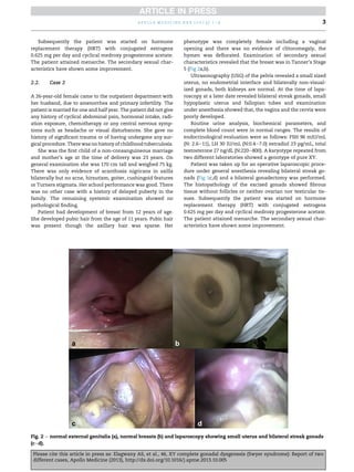 Subsequently the patient was started on hormone
replacement therapy (HRT) with conjugated estrogens
0.625 mg per day and cyclical medroxy progesterone acetate.
The patient attained menarche. The secondary sexual char-
acteristics have shown some improvement.
2.2. Case 2
A 26-year-old female came to the outpatient department with
her husband, due to amenorrhea and primary infertility. The
patient is married for one and half year. The patient did not give
any history of cyclical abdominal pain, hormonal intake, radi-
ation exposure, chemotherapy or any central nervous symp-
toms such as headache or visual disturbances. She gave no
history of signiﬁcant trauma or of having undergone any sur-
gical procedure. There was no history of childhood tuberculosis.
She was the ﬁrst child of a non-consanguineous marriage
and mother’s age at the time of delivery was 23 years. On
general examination she was 170 cm tall and weighed 75 kg.
There was only evidence of acanthosis nigricans in axilla
bilaterally but no acne, hirsutism, goiter, cushingoid features
or Turners stigmata. Her school performance was good. There
was no other case with a history of delayed puberty in the
family. The remaining systemic examination showed no
pathological ﬁnding.
Patient had development of breast from 12 years of age.
She developed pubic hair from the age of 11 years. Pubic hair
was present though the axillary hair was sparse. Her
phenotype was completely female including a vaginal
opening and there was no evidence of clitoromegaly, the
hymen was deﬂorated. Examination of secondary sexual
characteristics revealed that the breast was in Tanner’s Stage
5 (Fig 2a,b).
Ultrasonography (USG) of the pelvis revealed a small sized
uterus, no endometrial interface and bilaterally non-visual-
ized gonads, both kidneys are normal. At the time of lapa-
roscopy at a later date revealed bilateral streak gonads, small
hypoplastic uterus and fallopian tubes and examination
under anesthesia showed that, the vagina and the cervix were
poorly developed.
Routine urine analysis, biochemical parameters, and
complete blood count were in normal ranges. The results of
endocrinological evaluation were as follows: FSH 96 mIU/mL
(N: 2.6e11), LH 30 IU/mL (N:0.4e7.0) estradiol 23 pg/mL, total
testosterone 27 ng/dL (N:220e800). A karyotype repeated from
two different laboratories showed a genotype of pure XY.
Patient was taken up for an operative laparoscopic proce-
dure under general anesthesia revealing bilateral streak go-
nads (Fig 1c,d) and a bilateral gonadectomy was performed.
The histopathology of the excised gonads showed ﬁbrous
tissue without follicles or neither ovarian nor testicular tis-
sues. Subsequently the patient was started on hormone
replacement therapy (HRT) with conjugated estrogens
0.625 mg per day and cyclical medroxy progesterone acetate.
The patient attained menarche. The secondary sexual char-
acteristics have shown some improvement.
Fig. 2 e normal external genitalia (a), normal breasts (b) and laparoscopy showing small uterus and bilateral streak gonads
(ced).
a p o l l o m e d i c i n e x x x ( 2 0 1 3 ) 1 e4 3
Please cite this article in press as: Elagwany AS, et al., 46, XY complete gonadal dysgenesis (Swyer syndrome): Report of two
different cases, Apollo Medicine (2013), http://dx.doi.org/10.1016/j.apme.2013.10.005
 