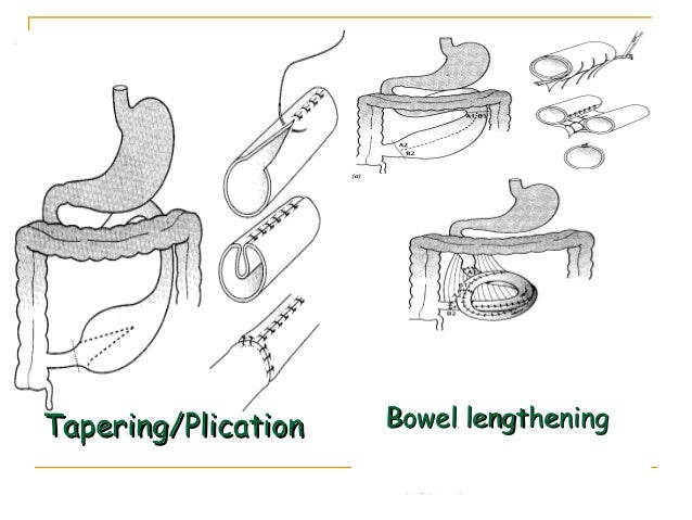 Short Bowel Syndrome (SBS), Short Gut Syndrome
