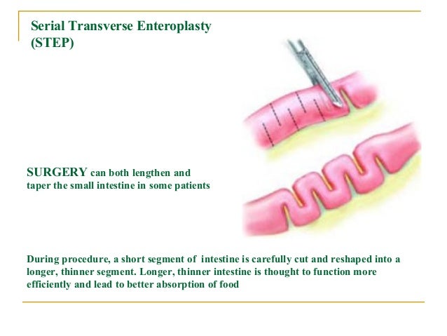Short Bowel Syndrome (SBS), Short Gut Syndrome