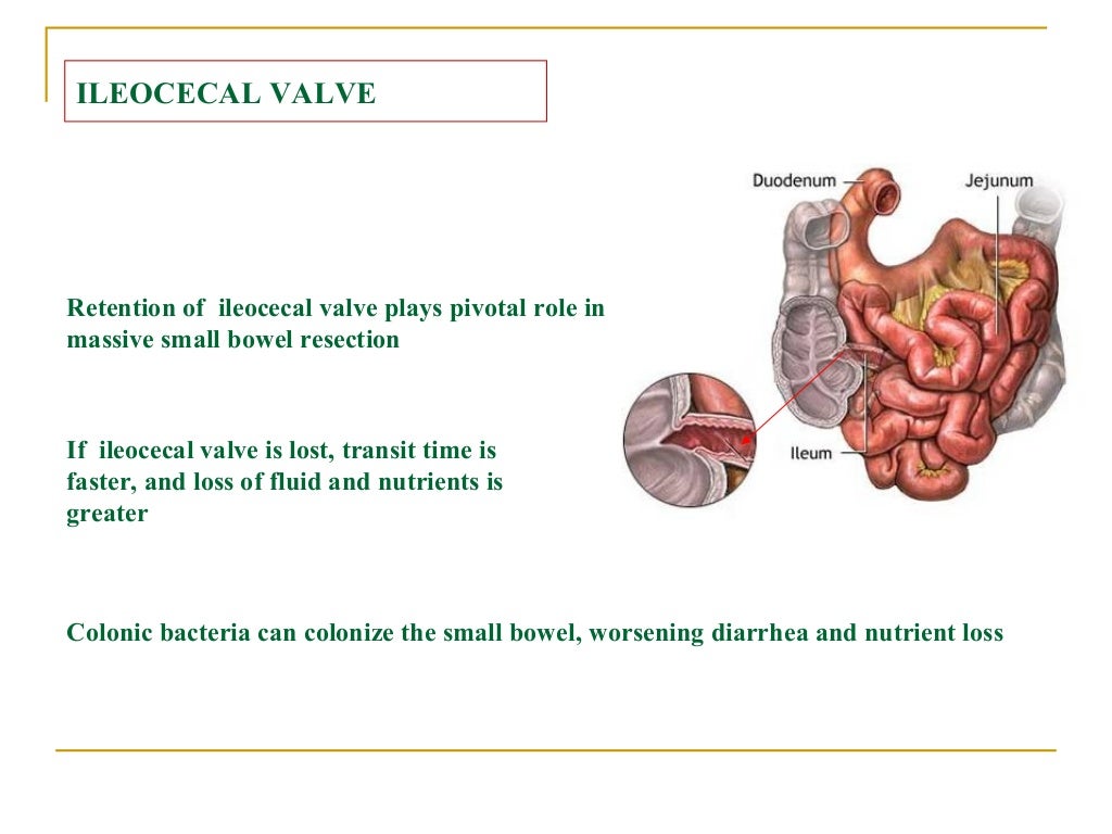 Short Bowel Syndrome (SBS), Short Gut Syndrome