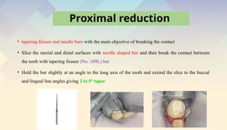 stainless steel crowns in pediatric dentistry | PPTX