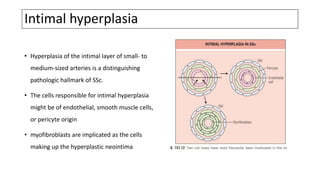 Intimal hyperplasia
• Hyperplasia of the intimal layer of small- to
medium-sized arteries is a distinguishing
pathologic hallmark of SSc.
• The cells responsible for intimal hyperplasia
might be of endothelial, smooth muscle cells,
or pericyte origin
• myofibroblasts are implicated as the cells
making up the hyperplastic neointima
 