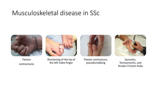 Musculoskeletal disease in SSc
Flexion
contractures
Shortening of the tip of
the left index finger
Flexion contracture,
pseudoclubbing
Synovitis,
Tenosynovitis, and
Tendon Friction Rubs
 