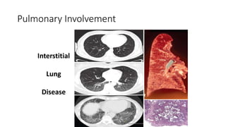 Pulmonary Involvement
Interstitial
Lung
Disease
 