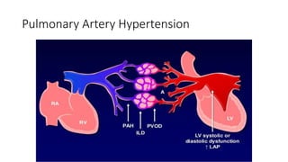 Pulmonary Artery Hypertension
 