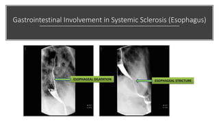 Gastrointestinal Involvement in Systemic Sclerosis (Esophagus)
 