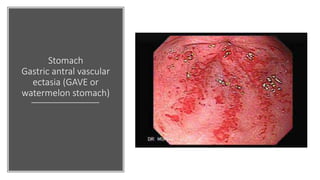 Stomach
Gastric antral vascular
ectasia (GAVE or
watermelon stomach)
 