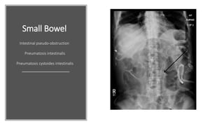 Small Bowel
Intestinal pseudo-obstruction
Pneumatosis intestinalis
Pneumatosis cystoides intestinalis
 