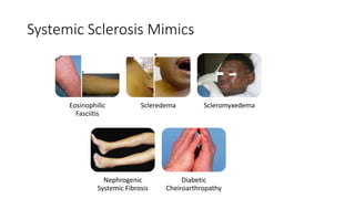 Systemic Sclerosis Mimics
Eosinophilic
Fasciitis
Scleredema Scleromyxedema
Nephrogenic
Systemic Fibrosis
Diabetic
Cheiroarthropathy
 