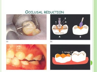 Stainless Steel Crowns In Pediatric Dentistry