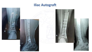 Iliac Autograft
 