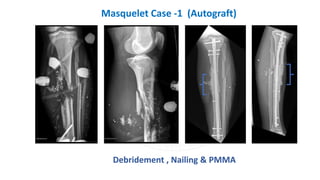 Debridement , Nailing & PMMA
Masquelet Case -1 (Autograft)
 