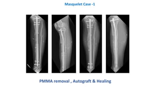 PMMA removal , Autograft & Healing
Masquelet Case -1
 
