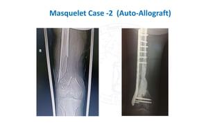 Masquelet Case -2 (Auto-Allograft)
 