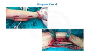 Masquelet Case -2
 