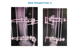 Bone Transport Case -2
 
