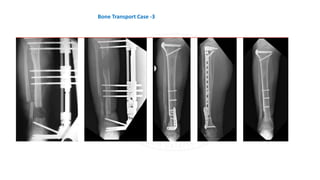 Bone Transport Case -3
 