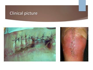 Surgical Site infections | PPTX