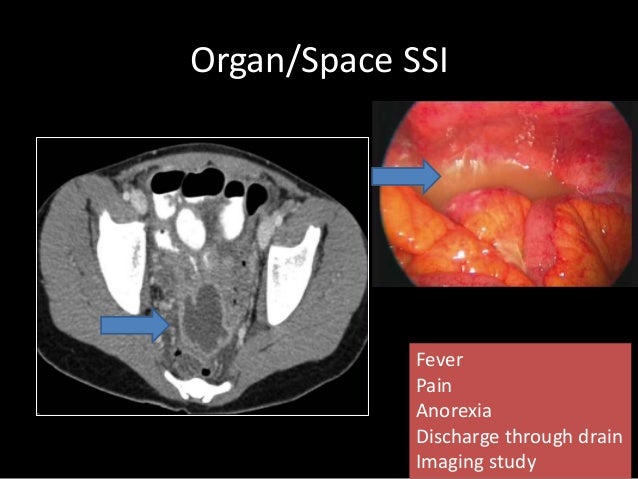 Surgical site infections: Latest Approach on management.