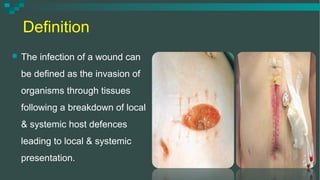 surgical wound infection