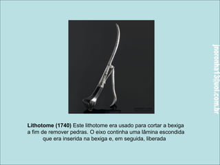 Lithotome (1740) Este lithotome era usado para cortar a bexiga 
a fim de remover pedras. O eixo continha uma lâmina escondida 
que era inserida na bexiga e, em seguida, liberada 
 