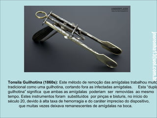 Tonsila Guilhotina (1860s): Este método de remoção das amígdalas trabalhou muito 
tradicional como uma guilhotina, cortando fora as infectadas amígdalas. Esta “dupla 
guilhotina” significa que ambas as amígdalas poderiam ser removidas ao mesmo 
tempo. Estes instrumentos foram substituídos por pinças e bisturis, no início do 
século 20, devido à alta taxa de hemorragia e do caráter impreciso do dispositivo, 
que muitas vezes deixava remanescentes de amígdalas na boca. 
 