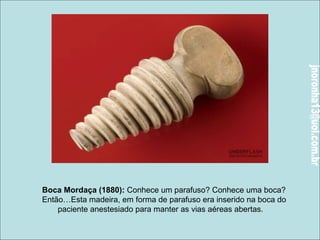 Boca Mordaça (1880): Conhece um parafuso? Conhece uma boca? 
Então…Esta madeira, em forma de parafuso era inserido na boca do 
paciente anestesiado para manter as vias aéreas abertas. 
 