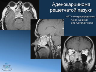 Аденокарцинома
       решетчатой пазухи
             МРТ с контрастированием
                Axial, Sagittal
                 and Coronal Views




2012
 