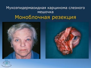 Мукоэпидермаоидная карцинома слезного
               мешочка
       Моноблочная резекция




2012
 