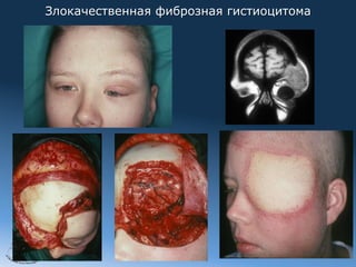 Злокачественная фиброзная гистиоцитома




2012
 