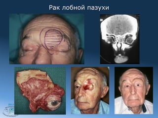 Рак лобной пазухи




2012
 