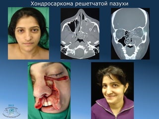 Хондросаркома решетчатой пазухи




2012
 