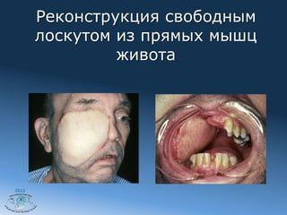 Реконструкция свободным
       лоскутом из прямых мышц
                живота




2012
 