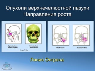 Опухоли верхнечелюстной пазухи
       Направления роста




2012
         Линия Онгрена
 