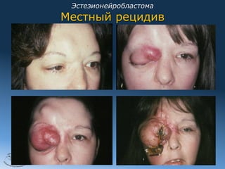 Эстезионейробластома
       Местный рецидив




2012
 