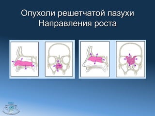 Опухоли решетчатой пазухи
          Направления роста




2012
 