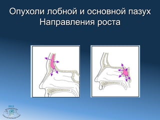 Опухоли лобной и основной пазух
      Направления роста




2012
 