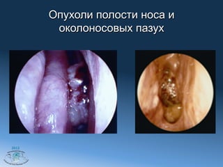 Опухоли полости носа и
        околоносовых пазух




2012
 