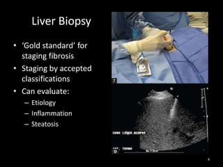 Liver Biopsy
• ‘Gold standard’ for
staging fibrosis
• Staging by accepted
classifications
• Can evaluate:
– Etiology
– Inflammation
– Steatosis

4

 