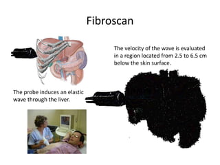 Fibroscan
The velocity of the wave is evaluated
in a region located from 2.5 to 6.5 cm
below the skin surface.

The probe induces an elastic
wave through the liver.

25 to 65 mm

8

 