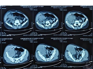 Acute appendicitis presenting as anterior abdominal wall abscess | PPTX