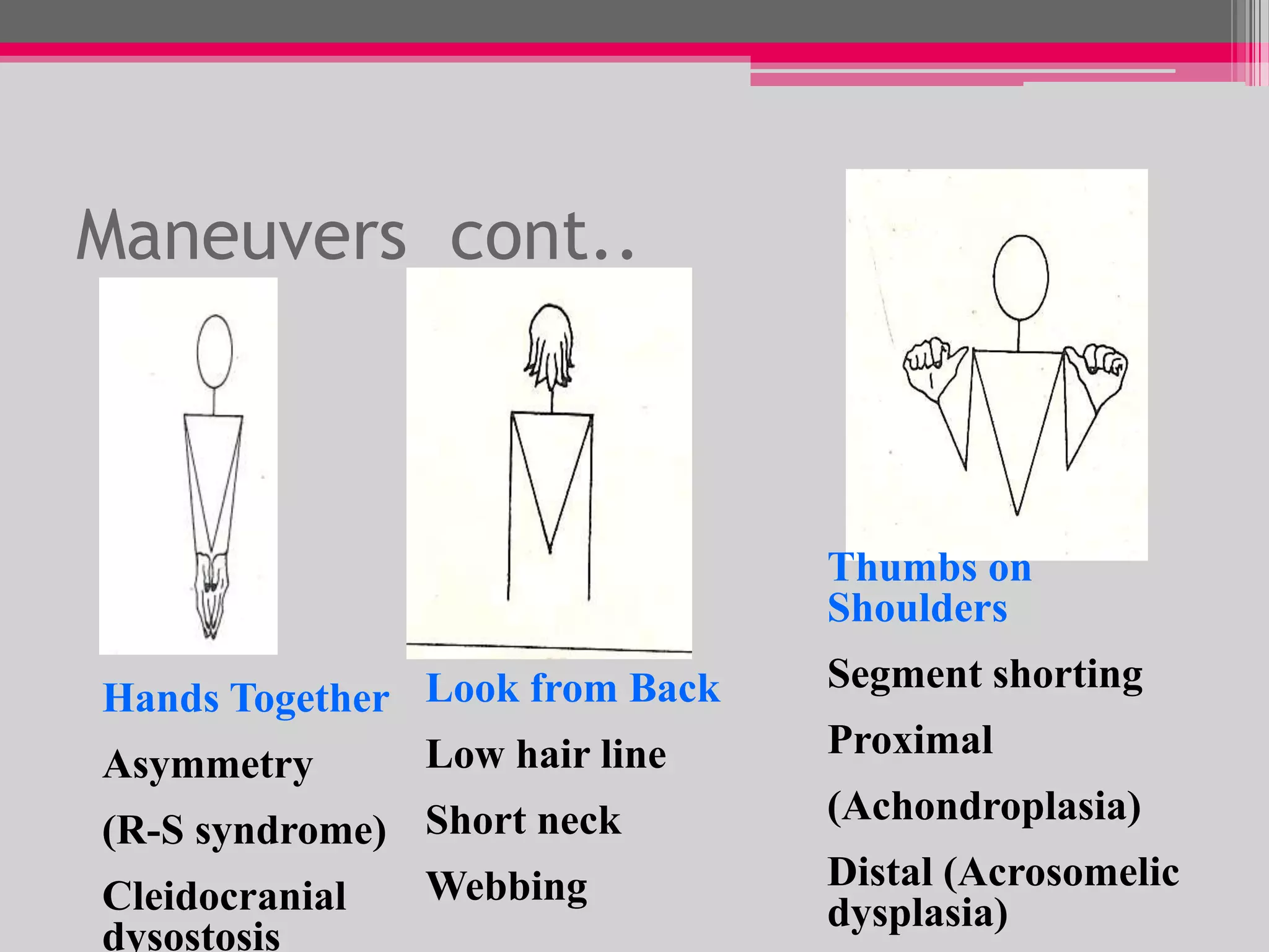 Maneuvers cont..

Thumbs on
Shoulders
Hands Together Look from Back
Low hair line
Asymmetry

Segment shorting

(R-S syndrome) Short neck
Webbing
Cleidocranial
dysostosis

(Achondroplasia)

Proximal
Distal (Acrosomelic
dysplasia)

 