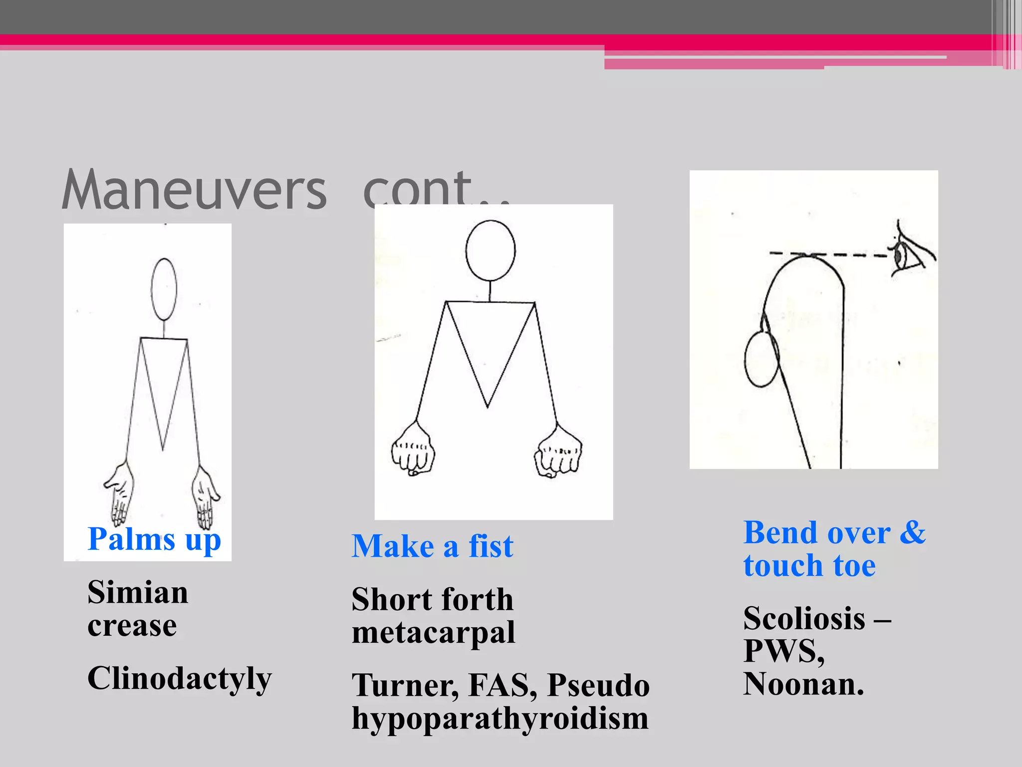 Maneuvers cont..

Palms up

Make a fist

Simian
crease

Bend over &
touch toe

Short forth
metacarpal

Clinodactyly

Turner, FAS, Pseudo
hypoparathyroidism

Scoliosis –
PWS,
Noonan.

 