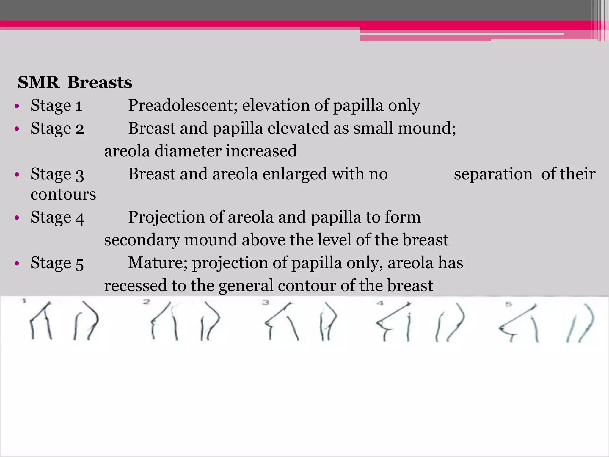SMR Breasts
• Stage 1
Preadolescent; elevation of papilla only
• Stage 2
Breast and papilla elevated as small mound;
areola diameter increased
• Stage 3
Breast and areola enlarged with no
separation of their
contours
• Stage 4
Projection of areola and papilla to form
secondary mound above the level of the breast
• Stage 5
Mature; projection of papilla only, areola has
recessed to the general contour of the breast

 